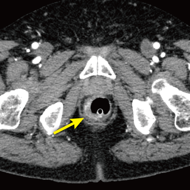 戸畑共立病院[ct]image report case 5 直肠肿疡の疑い
